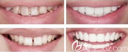 周杰醫(yī)生做美容冠案例 周杰醫(yī)生做美容冠案例