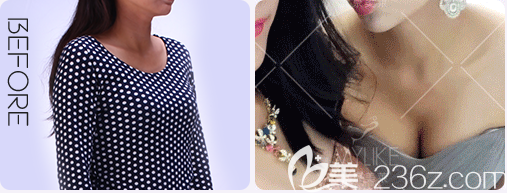 北京美萊黃杰醫(yī)生自體脂肪豐胸案例