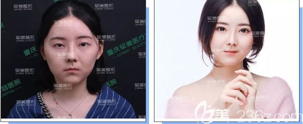 重慶軍美整形雙眼皮案例