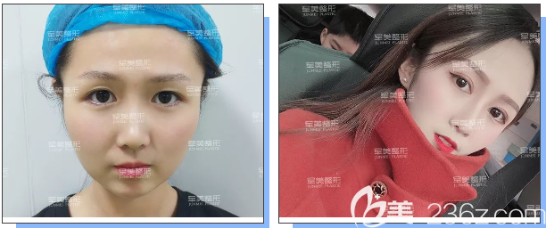 重慶軍美上眼瞼下垂矯正案例