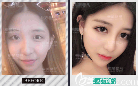 重慶軍美雙眼皮怎么樣