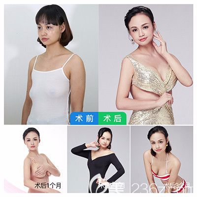 廣州曙光吳毅平隆胸案例效果圖