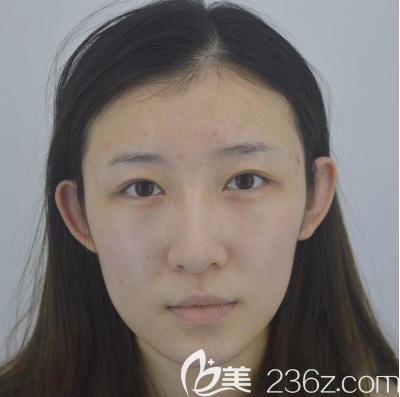 在佛山華美做雙眼皮術(shù)前照片 在佛山華美做雙眼皮術(shù)前照片