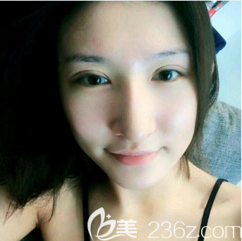 佛山華美雷朝勇雙眼皮案例7天自拍 佛山華美雷朝勇雙眼皮案例7天自拍