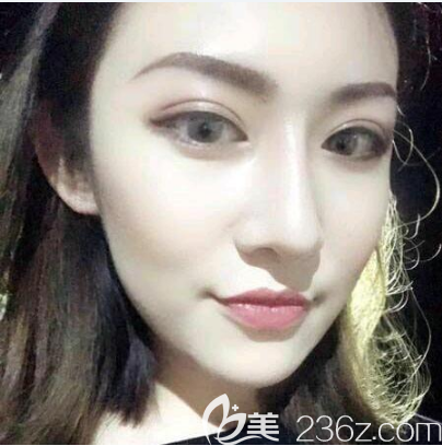 在網(wǎng)上看了佛山華美雷朝勇做的雙眼皮案例后就決定找他做眼綜合