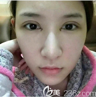 雷朝勇做過的雙眼皮案例術(shù)后三天 雷朝勇做過的雙眼皮案例術(shù)后三天