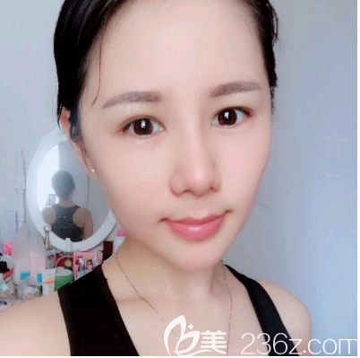 佛山華美雷朝勇肋軟骨隆鼻案例