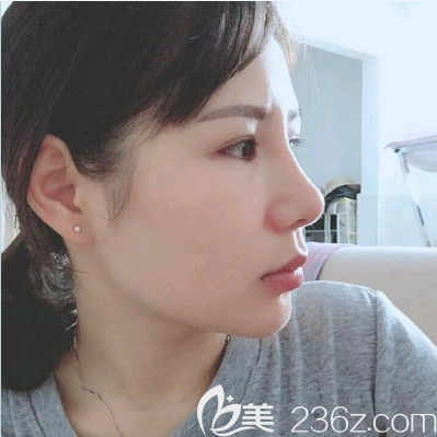 雷朝勇做的隆鼻案例一個(gè)月側(cè)面效果圖