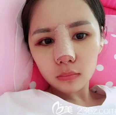 佛山華美肋軟骨隆鼻術(shù)后天