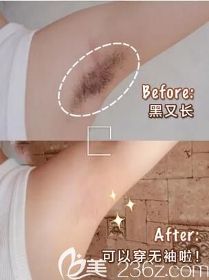 冰點(diǎn)脫腋毛真人前后效果展示