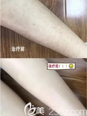 冰點(diǎn)脫腿毛真人前后展示