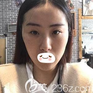 鄭州華領(lǐng)全面部PPDO<span style= 鄭州華領(lǐng)全面部PPDO<span style=