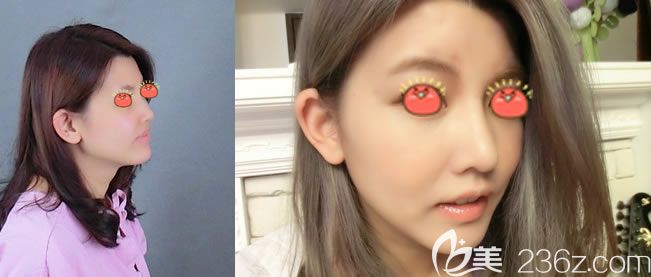 東陽麗萊楊建榮鼻綜合隆鼻案例