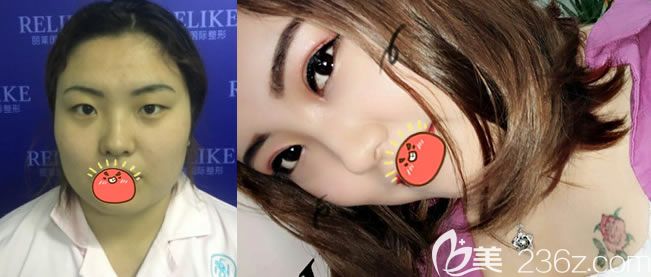 東陽麗萊<!--<i data=20240703-sp></i>-->割雙眼皮和開眼角案例