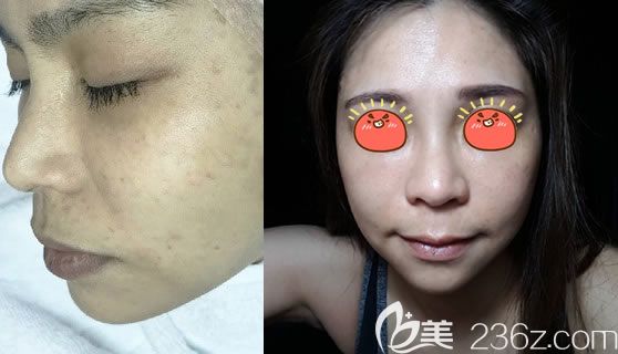 東陽麗萊鄧飛艷激光祛斑案例 東陽麗萊鄧飛艷激光祛斑案例