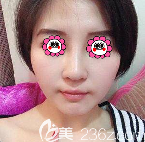 在北京雅靚做鼻修復(fù)第17天效果