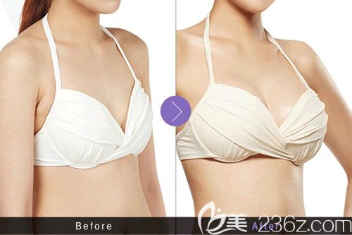 東陽麗萊沈干院長隆胸案例