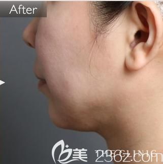 日本哪家醫(yī)院做下巴吸脂更專業(yè)? THE CLINIC大橋昌敬成功幫我塑造童顏小V臉