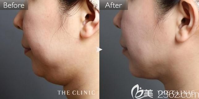  THE CLINIC大橋昌敬下巴吸脂前后對(duì)比