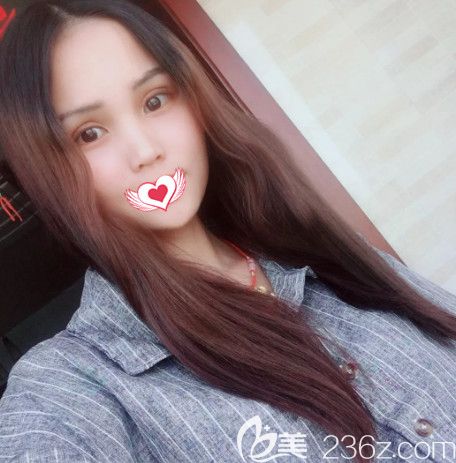 蔡鵬武醫(yī)生做眼綜合術(shù)后7天進(jìn)行拆線(xiàn)