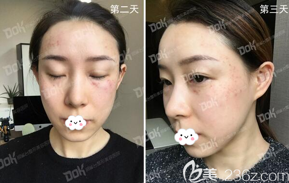 激光祛斑治療術(shù)后恢復(fù)期圖片 激光祛斑治療術(shù)后恢復(fù)期圖片