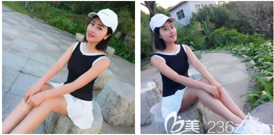 我在廣州藝美找張濤做完寶麗太大腿吸脂才10天就消腫恢復正常了