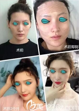 懷化華美脂肪微分面部填充真人前后效果對(duì)比