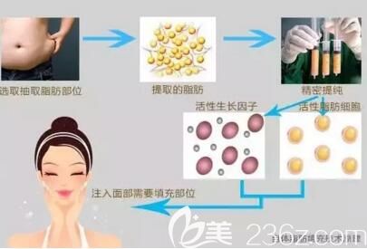 吸脂填充面部流程