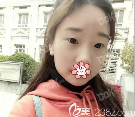 雙眼皮術前眼睛無神眼距寬 雙眼皮術前眼睛無神眼距寬