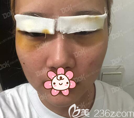 切開雙眼皮+開眼角術后即刻 切開雙眼皮+開眼角術后即刻
