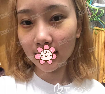 成都銅雀臺雙眼皮拆線后照片 成都銅雀臺雙眼皮拆線后照片