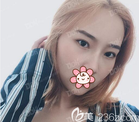 切開雙眼皮+開眼角術后照片 切開雙眼皮+開眼角術后照片