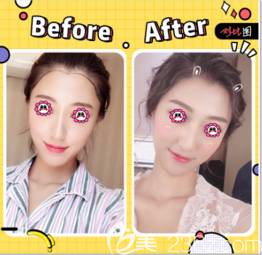 北京碧蓮盛袁國(guó)安醫(yī)生美人尖種植案例