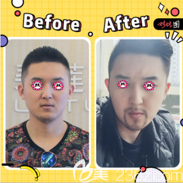 北京碧蓮盛張鵬程醫(yī)生胡須種植案例