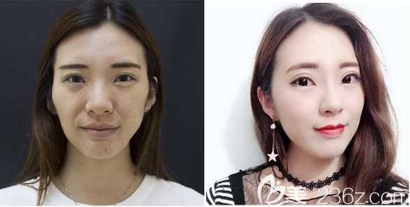 佛山佳麗整形于立民做的脂肪填充案例 佛山佳麗整形于立民做的脂肪填充案例