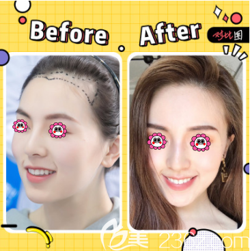 北京碧蓮盛楊志祥醫(yī)生發(fā)際線種植案例 北京碧蓮盛楊志祥醫(yī)生發(fā)際線種植案例