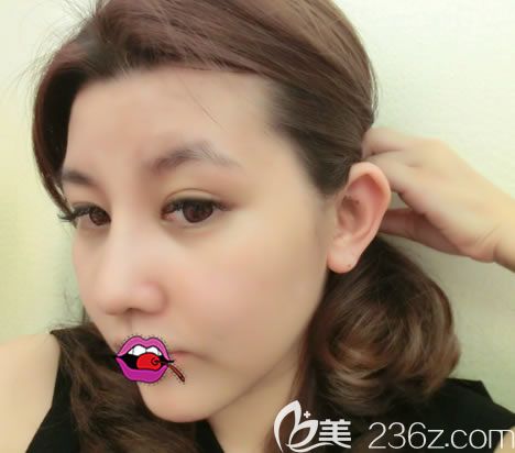 橫店麗萊整形耳軟骨隆鼻案例 橫店麗萊整形耳軟骨隆鼻案例