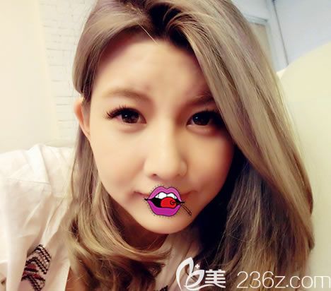 橫店麗萊整形隆鼻案例正面效果 橫店麗萊整形隆鼻案例正面效果