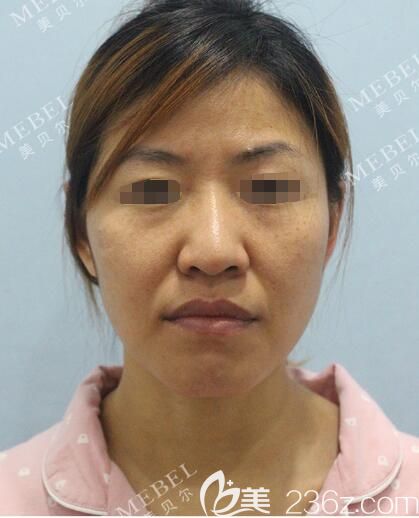 面診南京美貝爾術(shù)前面部初老明顯 面診南京美貝爾術(shù)前面部初老明顯