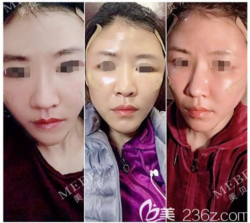 找杜瑞醫(yī)生剛做完線雕+自體脂肪面部填充 找杜瑞醫(yī)生剛做完線雕+自體脂肪面部填充