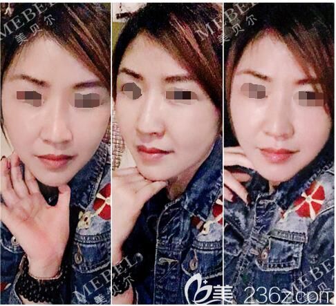 術(shù)后半個(gè)月線雕+自體脂肪填充面部恢復(fù)情況 術(shù)后半個(gè)月線雕+自體脂肪填充面部恢復(fù)情況