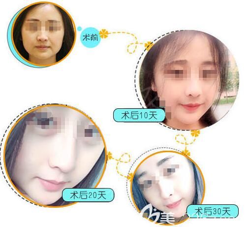 汪松林院長隆鼻案例 汪松林院長隆鼻案例