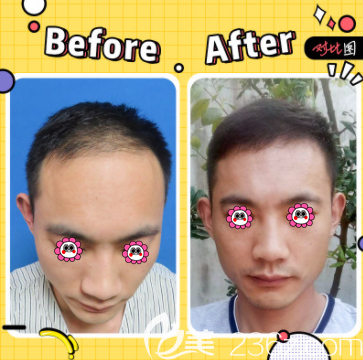 北京碧蓮盛陳彪醫(yī)生頭頂加密種植案例 北京碧蓮盛陳彪醫(yī)生頭頂加密種植案例