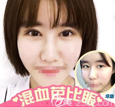 李景方醫(yī)生雙眼皮案例 李景方醫(yī)生雙眼皮案例