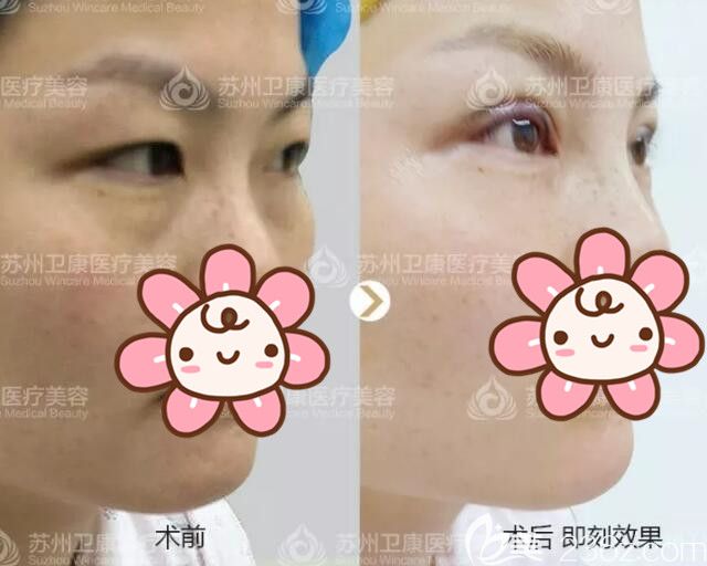 李景方醫(yī)生剛做完雙眼皮和術(shù)前對(duì)比