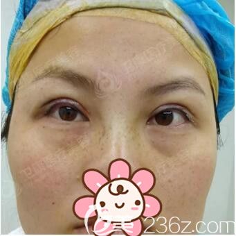 做完雙眼皮去皮去脂第二天恢復(fù)