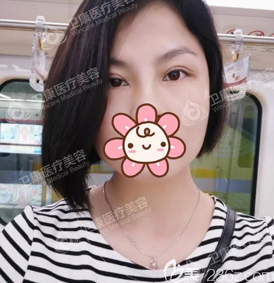 再三對比蘇州有排名的整形醫(yī)院后選定了蘇州衛(wèi)康李景方醫(yī)生做雙眼皮，8mm寬度很適合