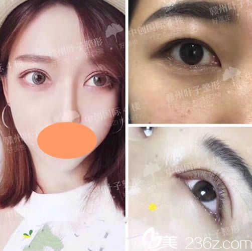 贛州葉子醫(yī)療美容雙眼皮前后對比圖
