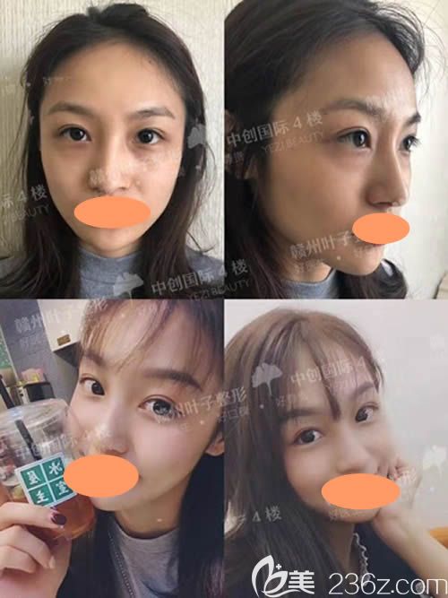 贛州葉子醫(yī)療美容鼻綜合整形前后對比圖
