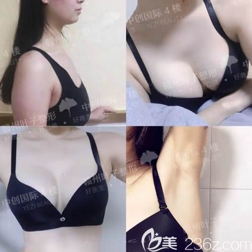 贛州葉子整形隆胸前后對比圖